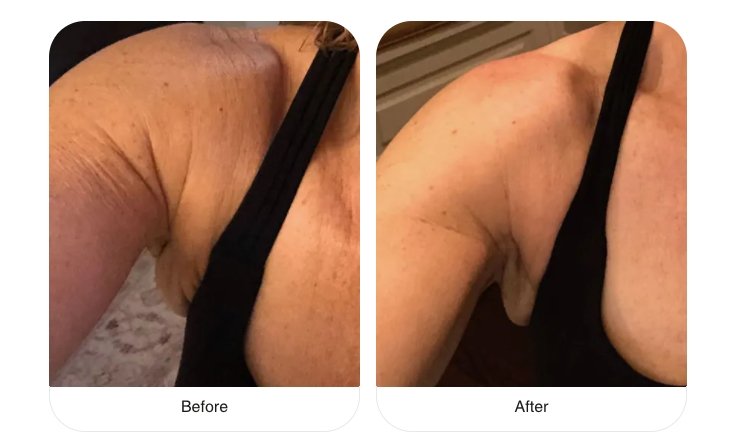 Before and after image of a woman's upper arm, showing reduced crepey skin after using Vitali's Skin Care products.