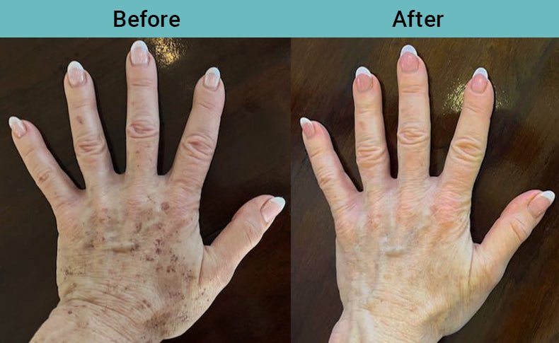 A woman's aging hands before and after using Vitali Regenerative Serum with IPL laser and squalane oil.