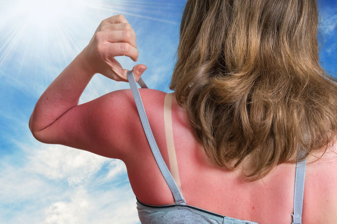 A woman holding out the strap of her shirt to show off sunburnt skin on her back.