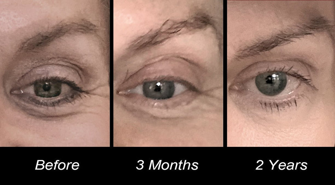 The progression of a woman's eye before, at 3 months, and at 2 years of using Vitali's pro-aging eye cream.