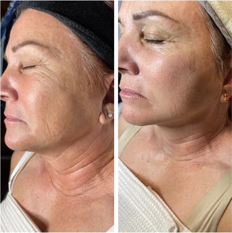 Two close ups of a woman's face, showing before and after 3 micro-needling treatments using Vitali's Restoracell Skin Cell Restoration Serum.