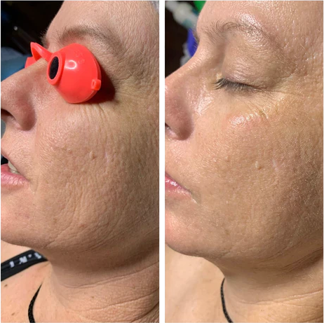 Close ups of a woman's face, showing before and after 3 micro-needling treatments using Vitali's Restoracell Skin Cell Restoration Serum.